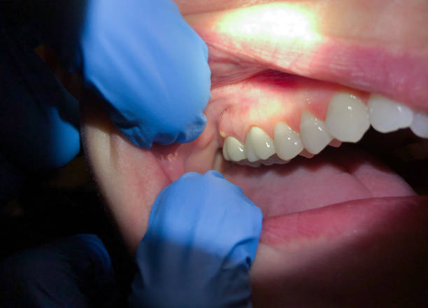Best Emergency Dentist for Knocked-Out Tooth in The Villages, FL